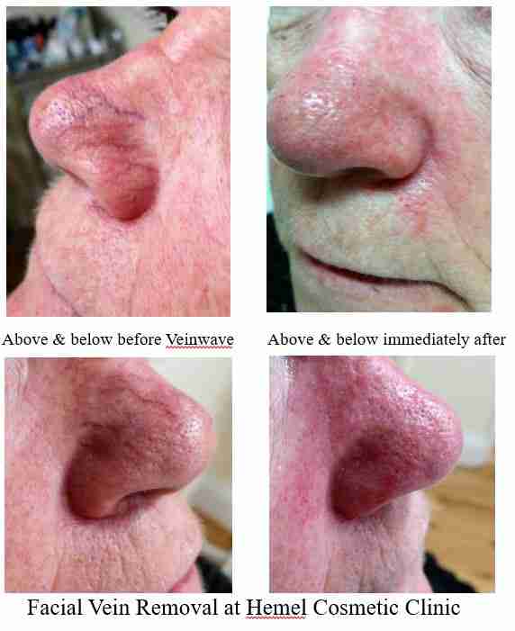 Facial Vein Removal Cost 88