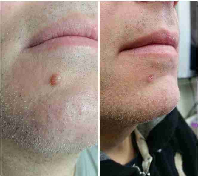 Facial Mole Removal Photos 99