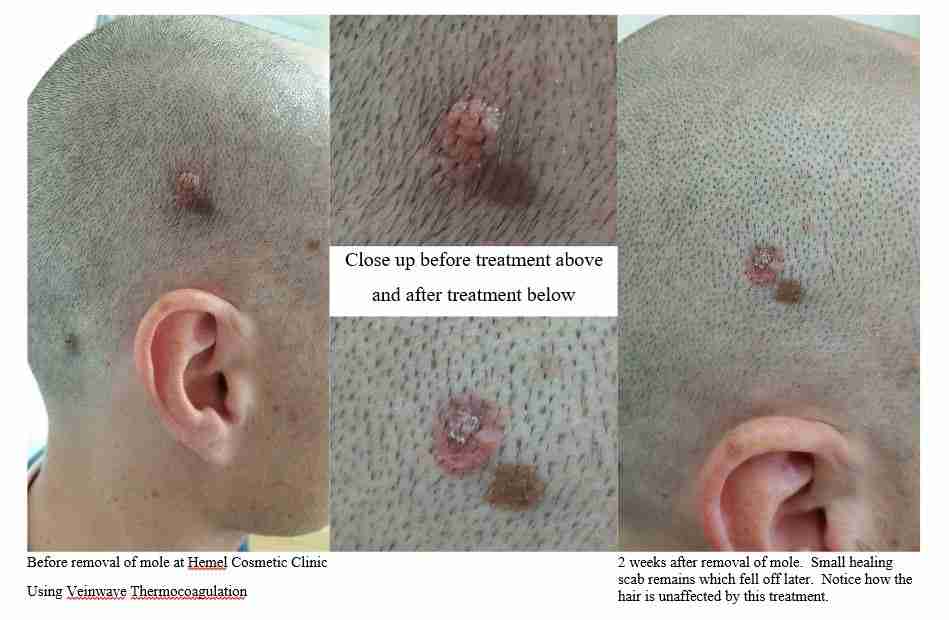 Before & after mole removal Hemel Hempstead