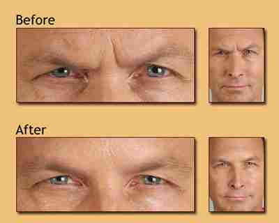 Botox for men - Before and after
