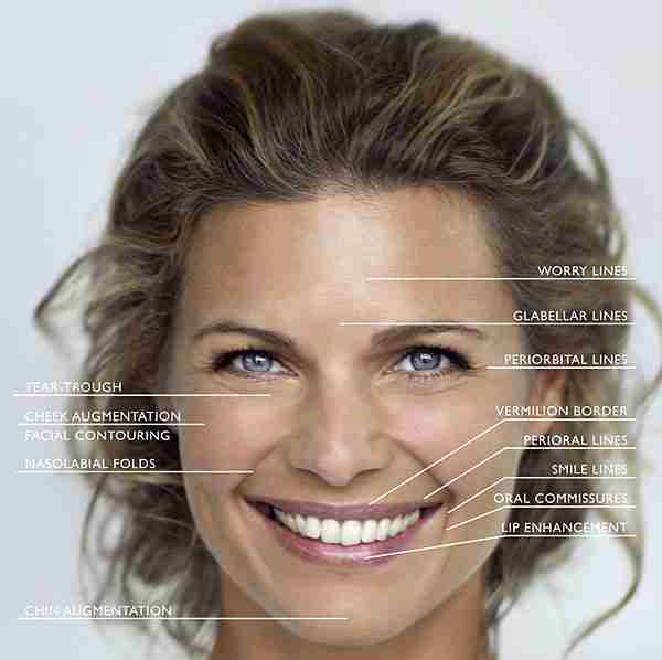 Dermafillers - Face map