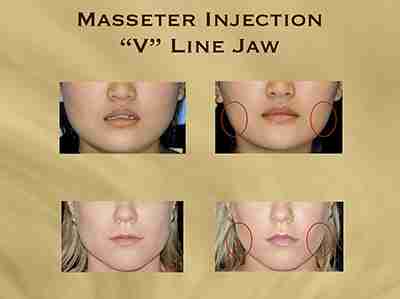 Jaw-line-contouring-1