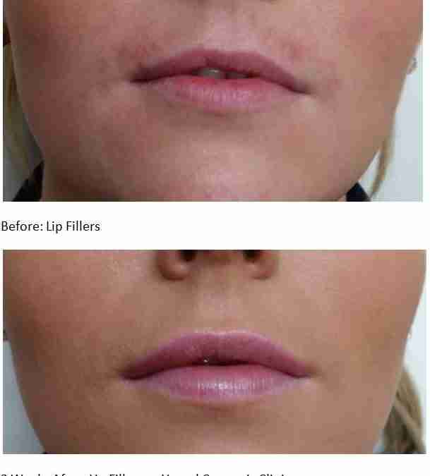 Lip Filler Review from Whatclinic.com