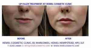 Lip Fillers before & after at Hemel Cosmetic Clinic Hemel Hempstead