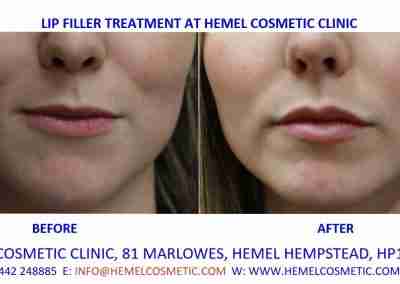 Lip Fillers before & after at Hemel Cosmetic Clinic Hemel Hempstead