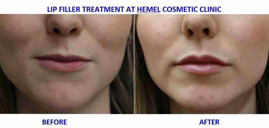 Lip Fillers Before & After: Treatment at Hemel Cosmetic Clinic