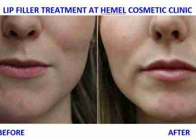 Non-Surgical Cosmetic Treatments in Hemel Hempstead. Hemel Cosmetic Clinic is dedicated to helping you achieve the look you have always wanted!
