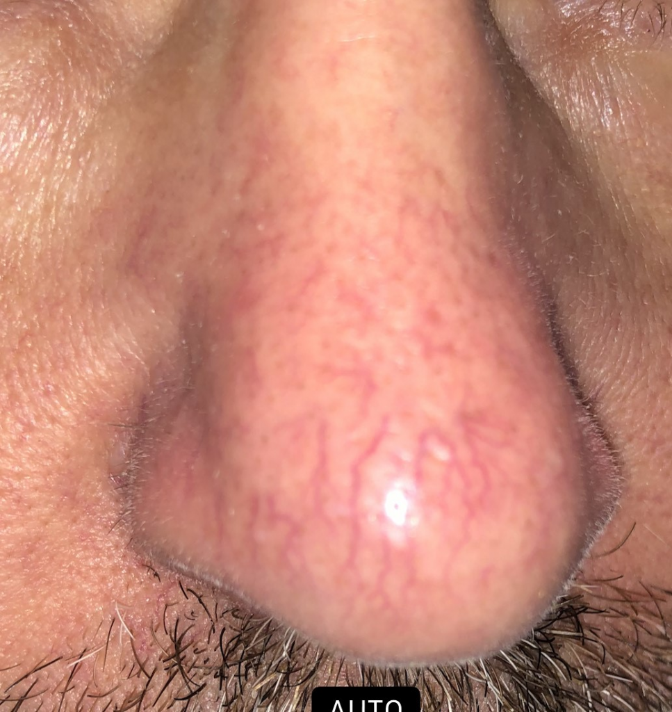 Thread veins on nose, removal, Hemel Cosmetic Clinic, Hemel Hempstead