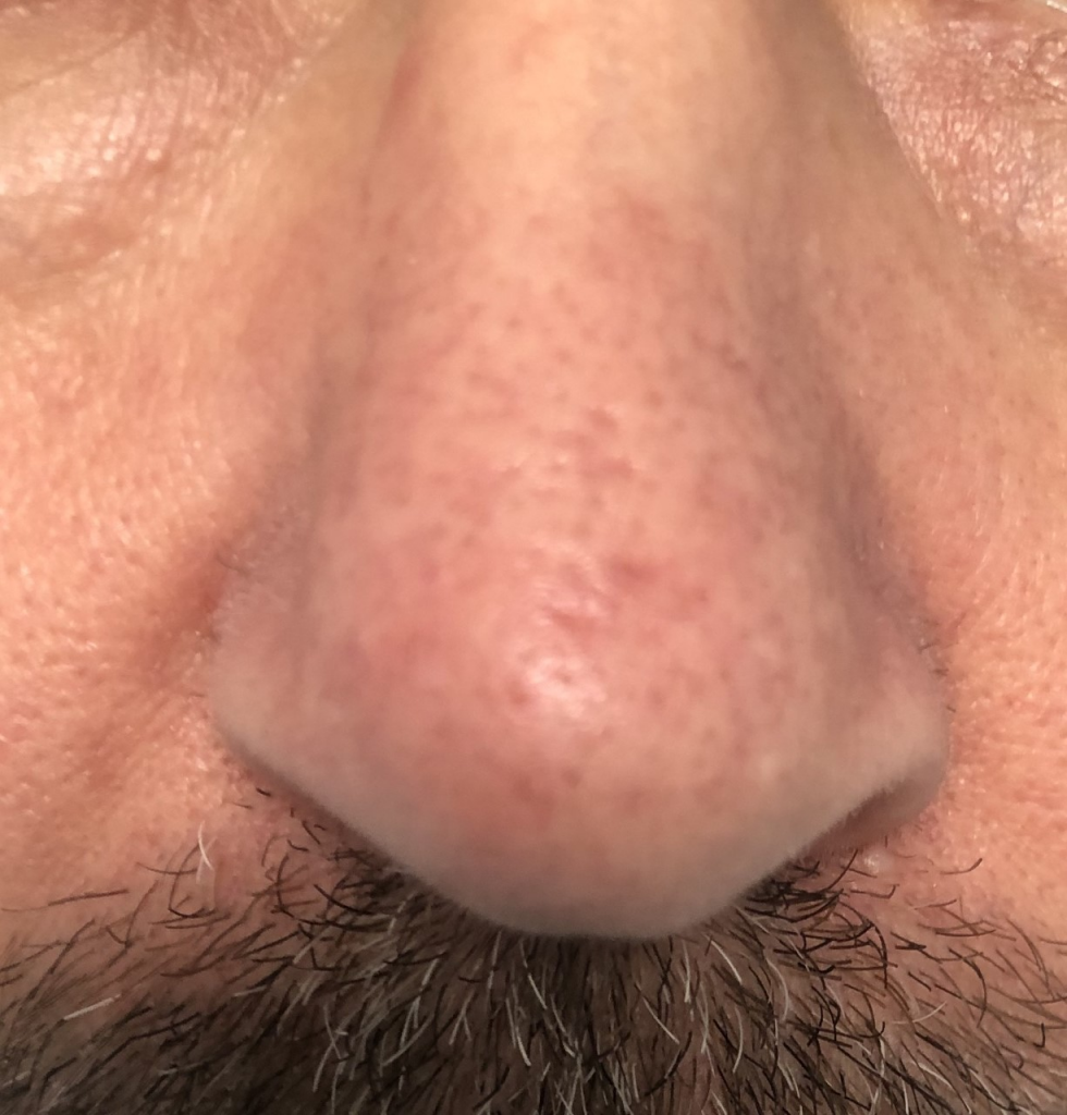 Thread veins on nose, removal, Hemel Cosmetic Clinic, Hemel Hempstead