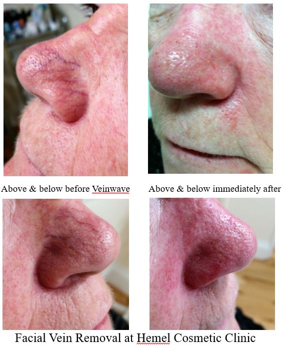 Thread and spider vein removal from face Hemel Hempstead, Kings Langley, Harpenden, Berkhamsted, Tring, Apsley